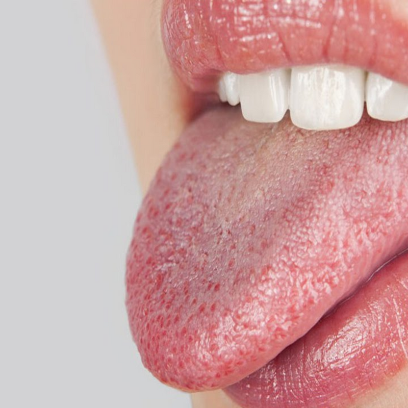 Understanding and Managing Dry Mouth: Causes, Symptoms, and Treatment Options