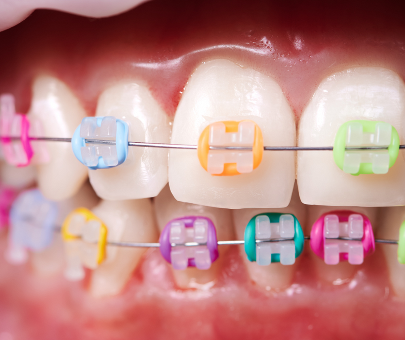 Taking Care of Your Teeth with Braces