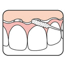 TePe Bridge & Implant Floss - Floss | SmileShop , Bridge, Floss, Super, Super Floss