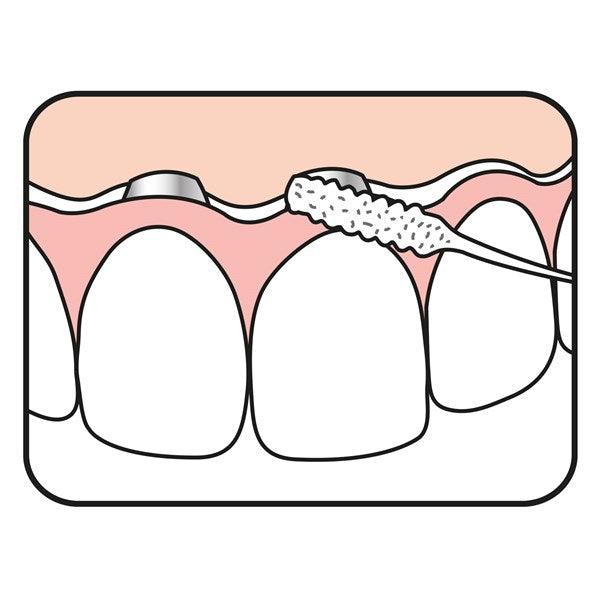 TePe Bridge & Implant Floss - Floss | SmileShop , Bridge, Floss, Super, Super Floss