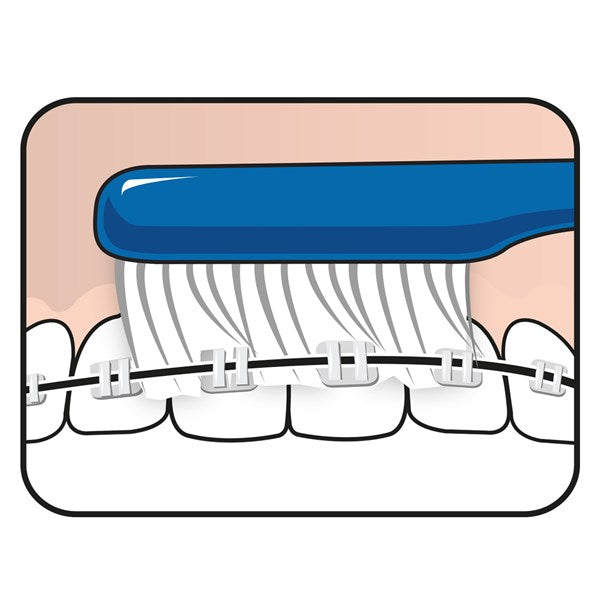 TePe Implant Orthodontic Brush™ 1 x Brush Soft Pack - Speciality Brush | SmileShop , Manual toothbrush, Speciality Brush, Sweden, TePe