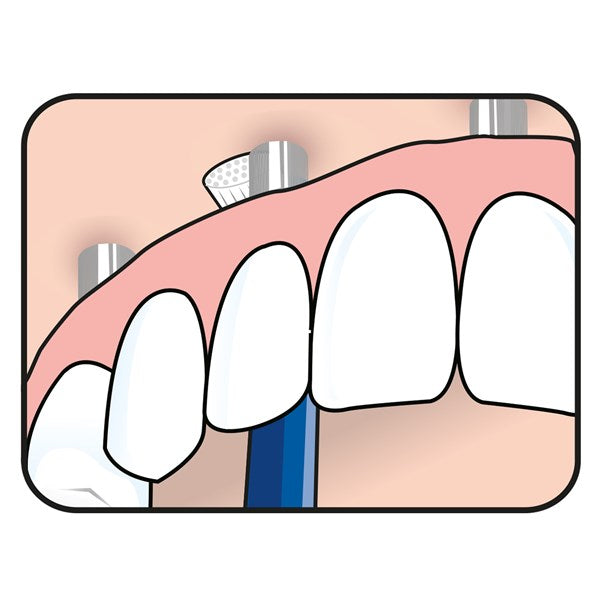 TePe Universal Care™ 1's Blister Pack - Speciality Toothbrush | SmileShop , Implant, Speciality Brush, Sweden, TePe